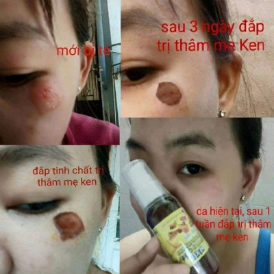 TINH CHẤT GIẢM THÂM MỤN VÀ SÁNG MỊN DA 50ML