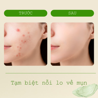 Mặt Nạ Đất Sét Rau Má Ngừa Mụn Mịn Da POP