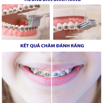 Bàn Chải Đánh Răng Dành Cho Răng Niềng Trisa Bracket Clean