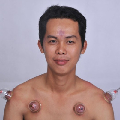 Bộ Giác Hơi Không Dùng Lửa Duy Thành YGH05 (6 ống giác)